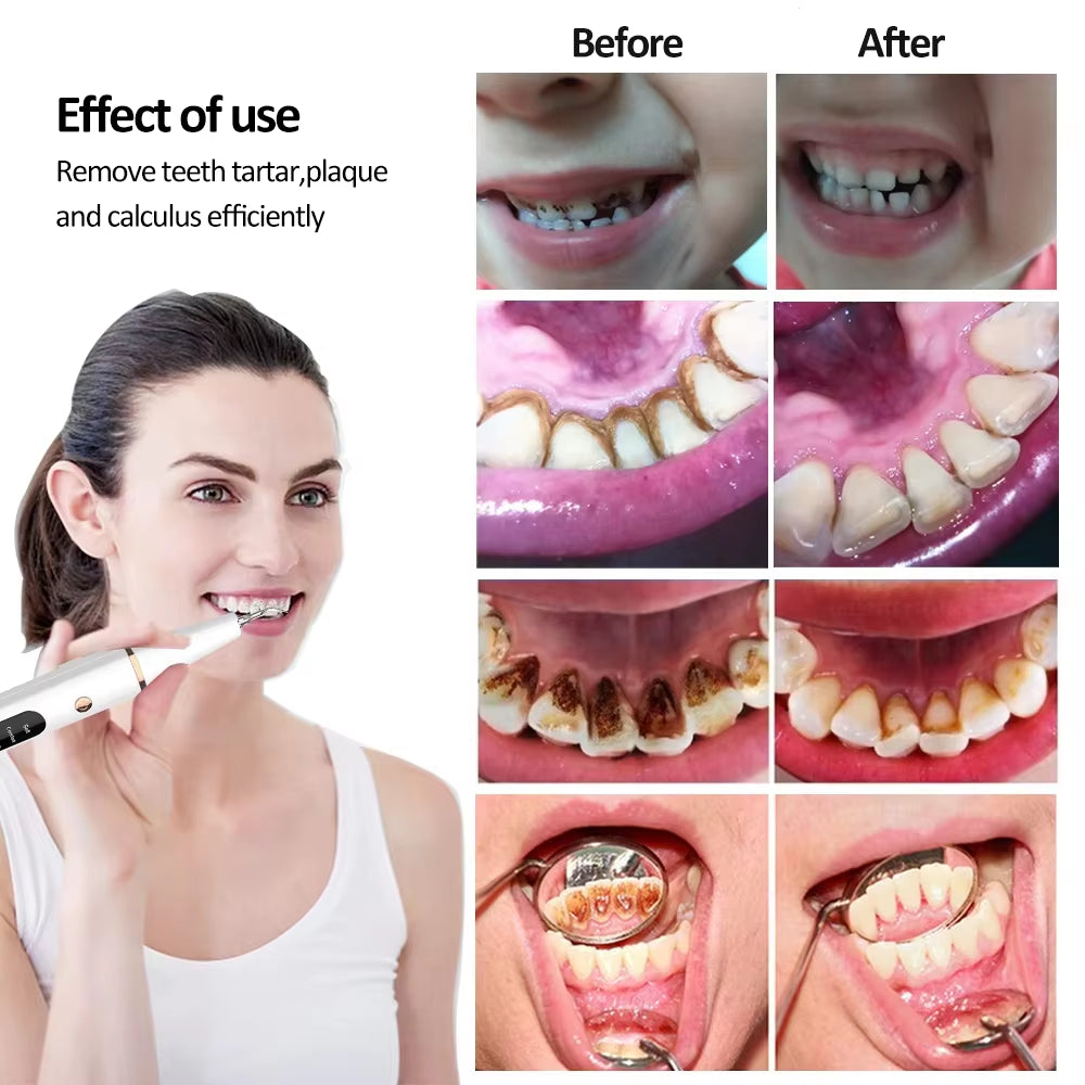 Ultrasonic Dental Calculus Remover and Plaque Scaler for Effective Tartar and Stain Elimination